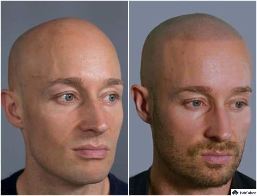 Haar-Tattoo nachher fotos